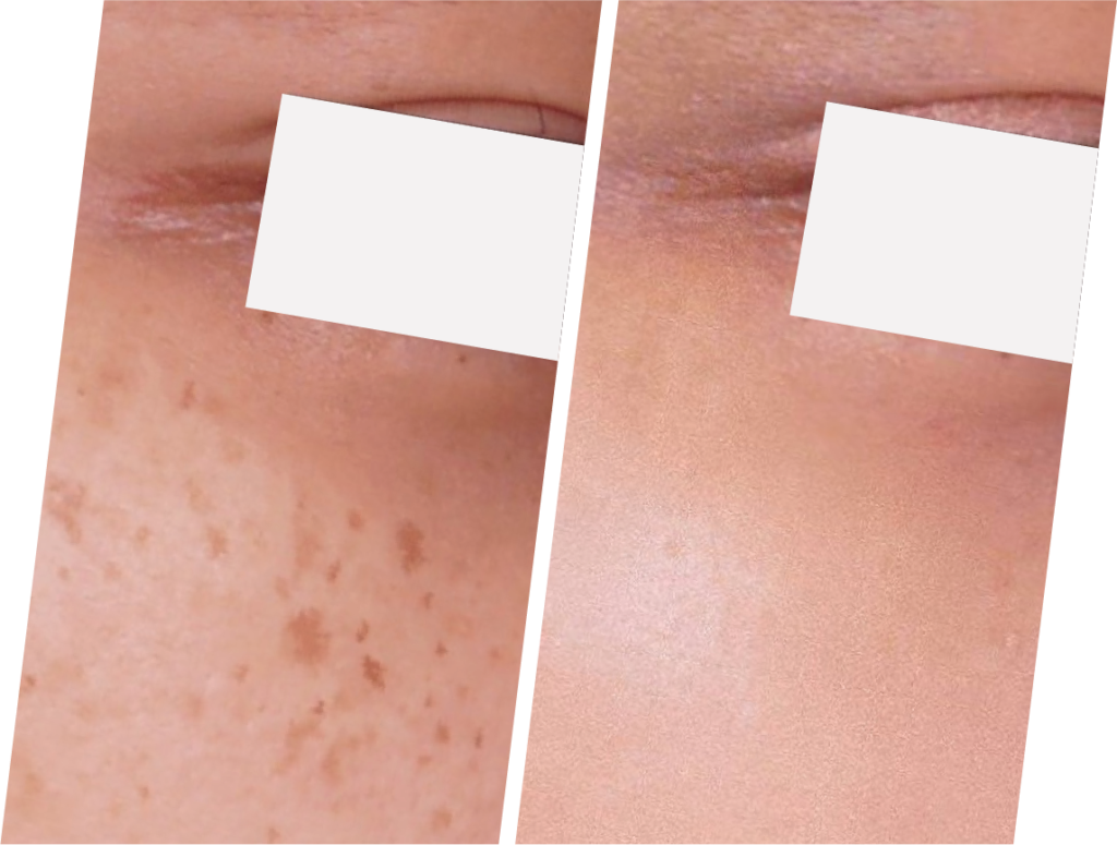 Pigmentation LP export-46