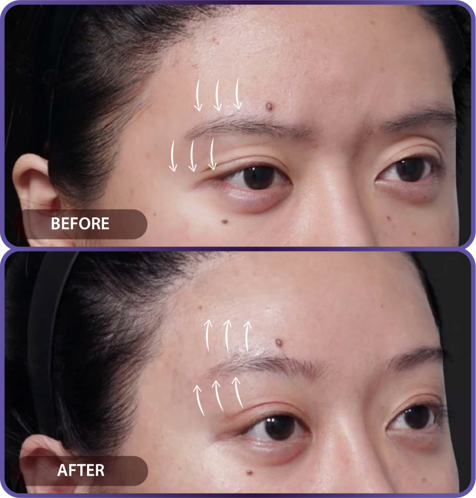 Ultherapy LP （hypercharge PC version)-20