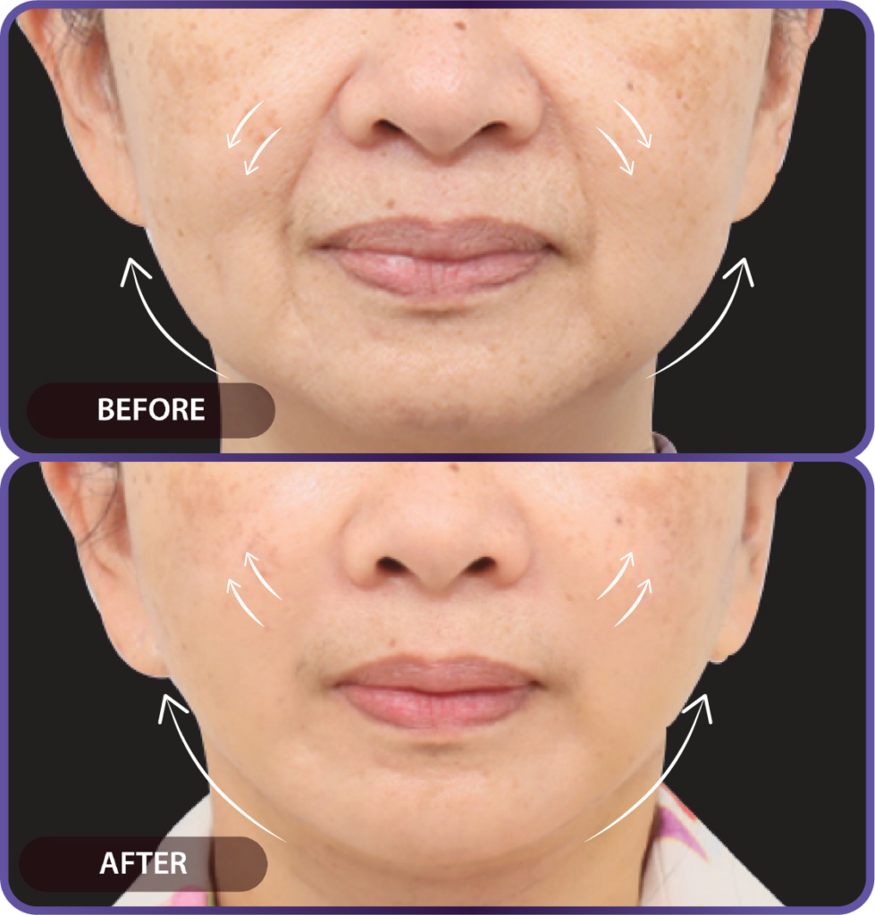 Ultherapy LP （hypercharge PC version)-21