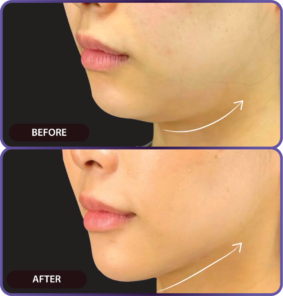 Ultherapy LP （hypercharge PC version)-22