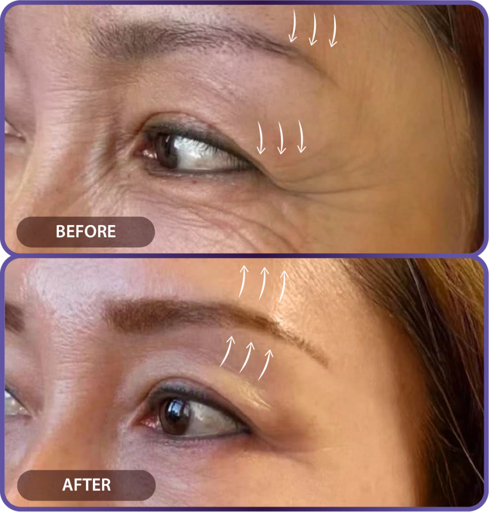Ultherapy LP （hypercharge PC version)-23