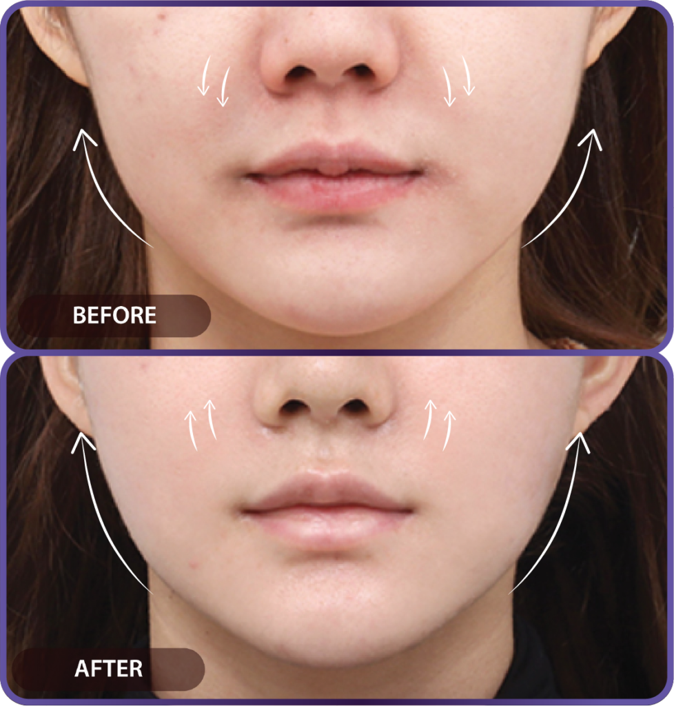 Ultherapy LP （hypercharge PC version)-25