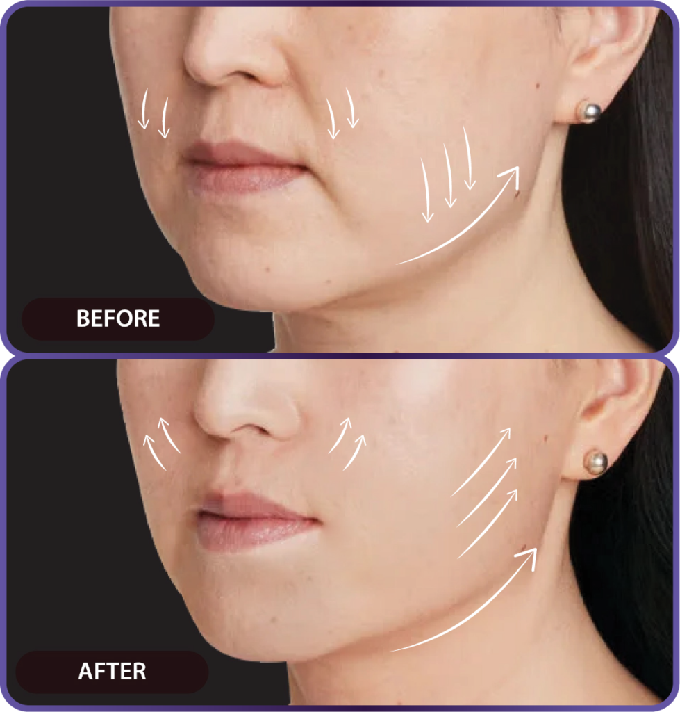 Ultherapy LP （hypercharge PC version)-26