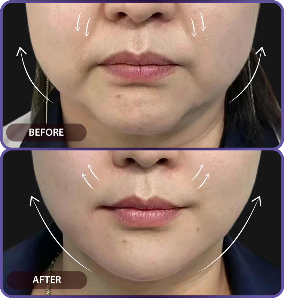 Ultherapy LP （hypercharge PC version)-27