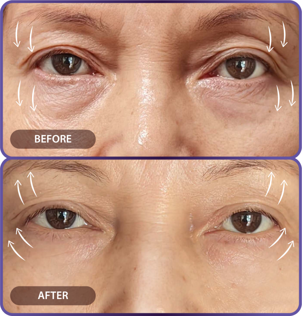 Ultherapy LP （hypercharge PC version)-28