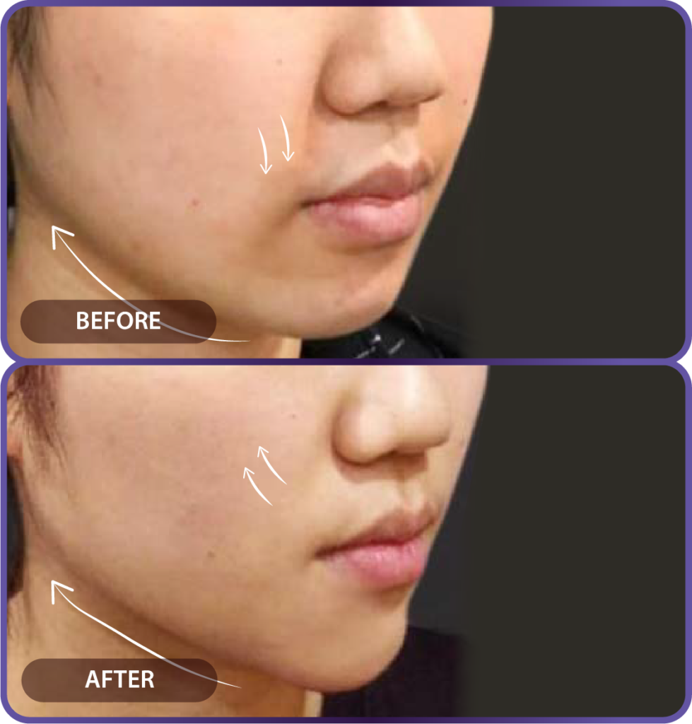 Ultherapy LP （hypercharge PC version)-29