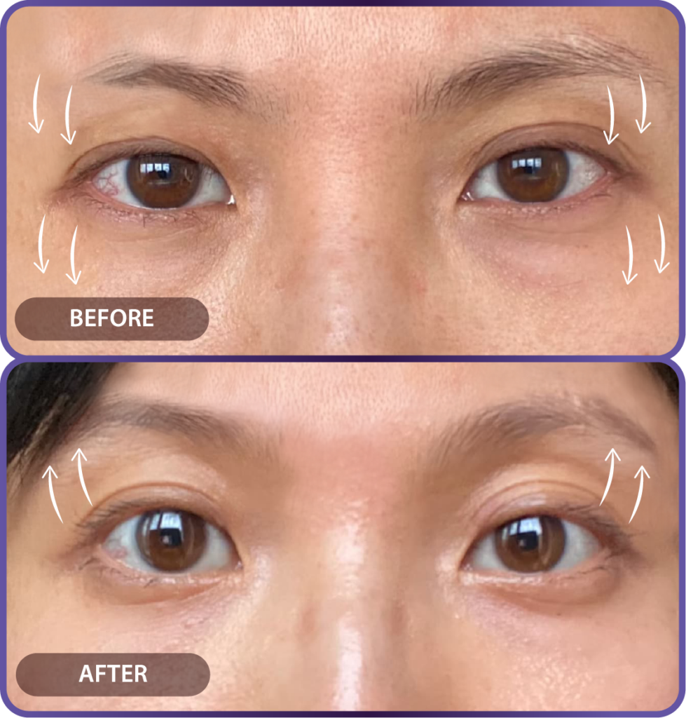 Ultherapy LP （hypercharge PC version)-30
