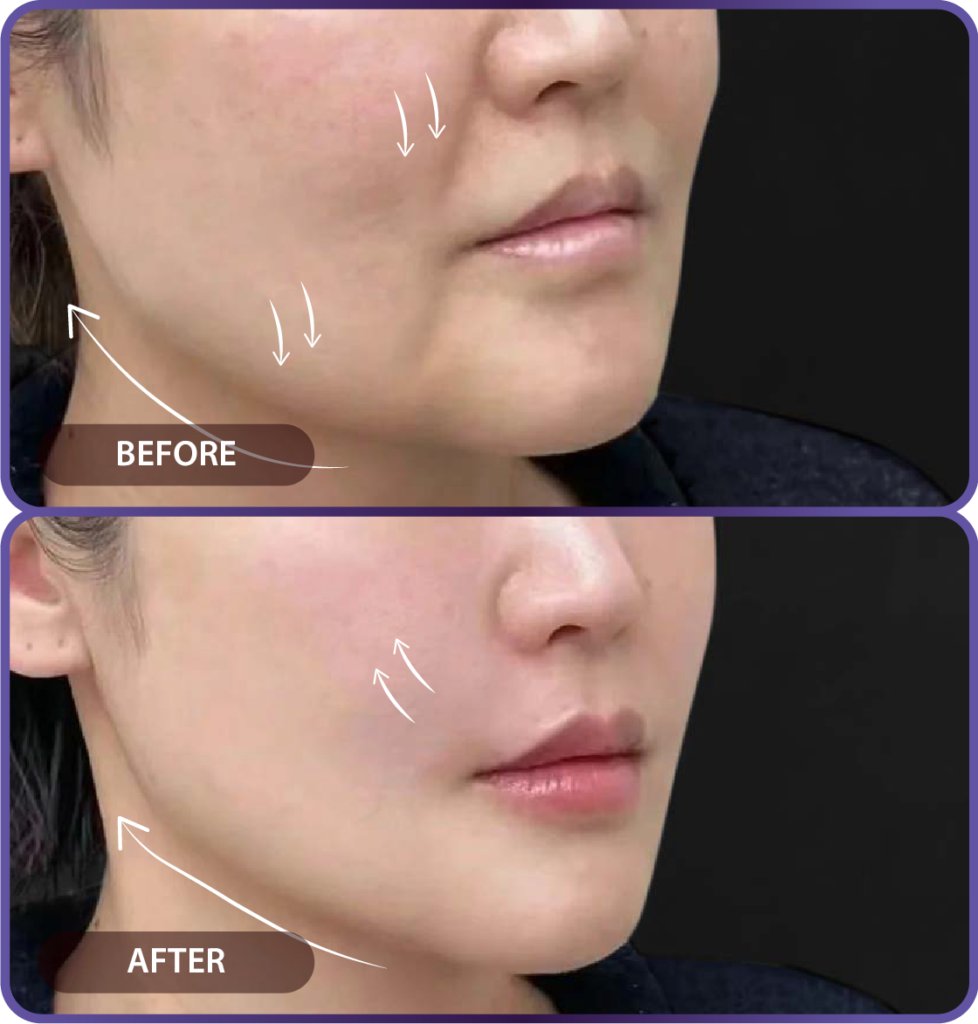 Ultherapy LP （hypercharge PC version)-31