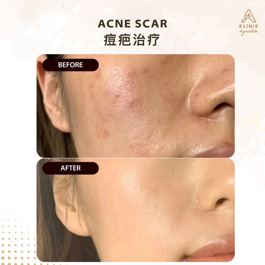 SCARS 4