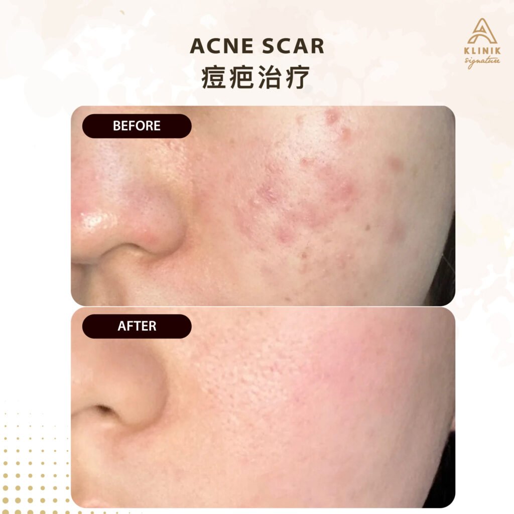 SCARS 5